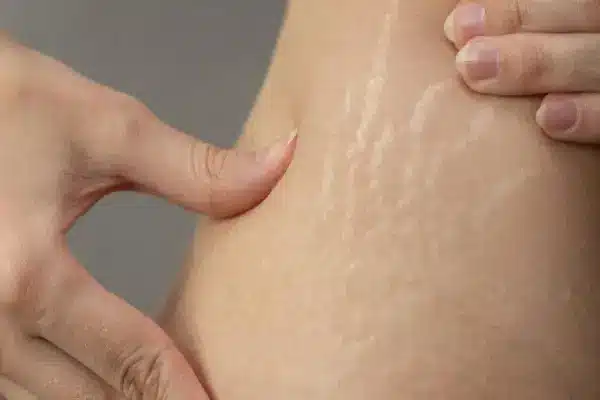 درمان ترک پوستی