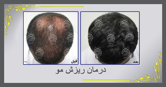 درمان ریزش مو و شوره سر