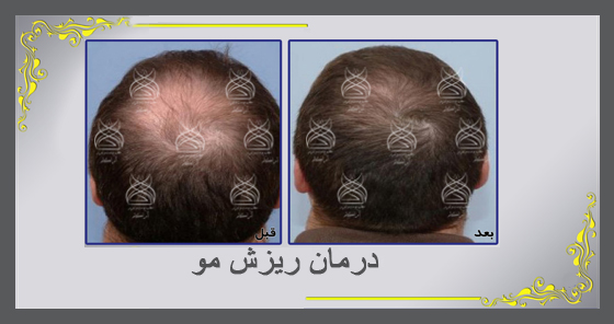 درمان ریزش مو و شوره سر